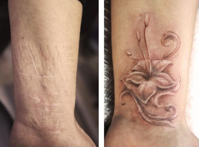 Перекрытие шрамов татуировкой лилия
